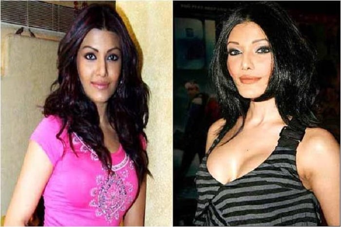 celebrities before and after plastic surgery gone wrong