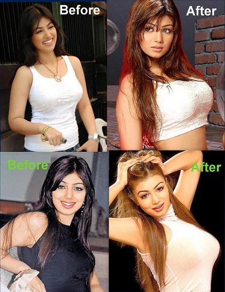 Photo Credit http://www.bollychitchat.in/bollywood-celebs-before-and-after-surgery/